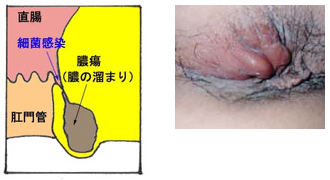 肛門周囲膿瘍