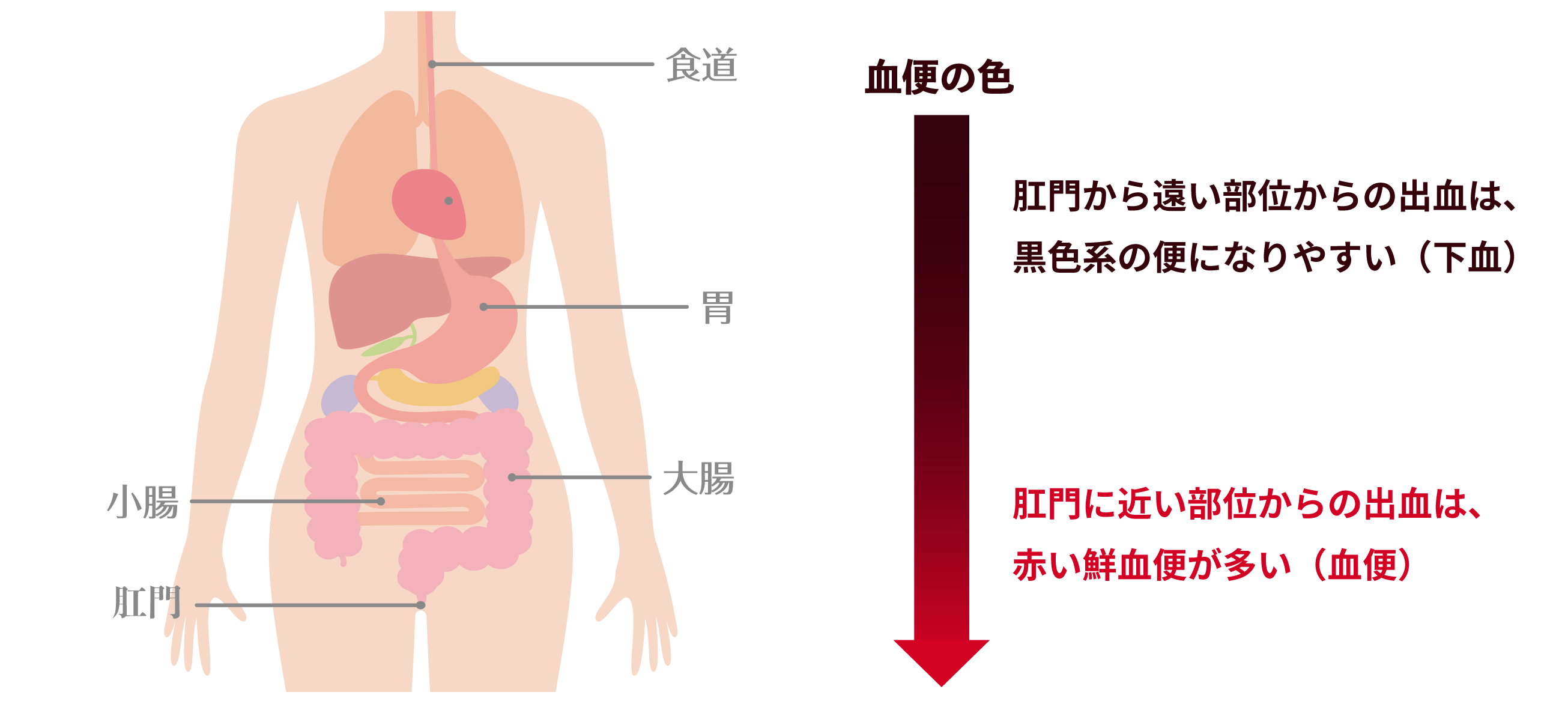 消化器部位と血便の色イメージ図